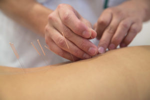Acupuncture for Psoriasis 