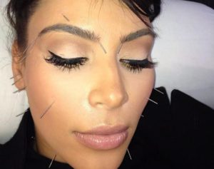Kim Kardashian Acupuncture